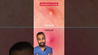 Dr Somji explains how to treat Acne Mild Moderate amp Severe Acne [upl. by Niattirb958]