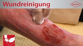 Wundreinigung Debridement bei chronischer Wunde  Verbandswechsel  DRACO [upl. by Aurelio]