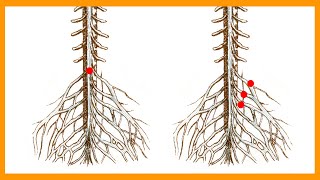 Cauda Equina vs Conus Medullaris Syndrome [upl. by Secrest794]