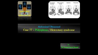 Ultrasound Case 77 Polysplenia Heterotaxy Syndrome [upl. by Acirdna262]