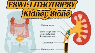 How to do Operation of Lithotripsy  ESWL Lithotripsy  Kidney Stone Treatment  Renal DJ Stent [upl. by Venita203]