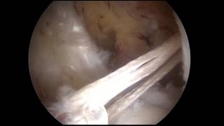 ACL Reconstruction with Single Bundle Hamstring Graft Graftlink [upl. by Eilata]