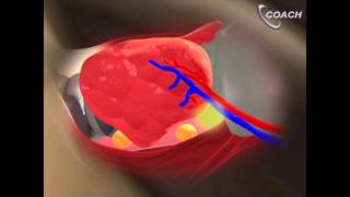 Minimally Invasive Total Thyroidectomy Video [upl. by Gnouhk]