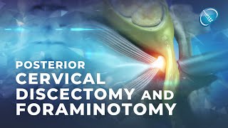 What is Endoscopic Posterior Cervical Discectomy and Foraminotomy [upl. by Farrington684]