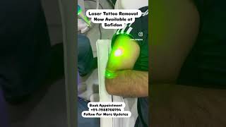 Laser Tattoo Removal laser tattooremoval laserhairremoval lasertreatment [upl. by Aserehs]