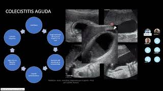 Ecografia de la Vesicula Biliar [upl. by Eelrebmik90]