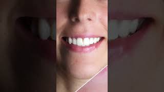 Before and After Hollywood Smile  Hollywood Dental İzmir 🇹🇷 [upl. by Zetra69]