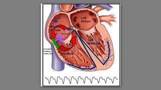 72 Phân biệt cơn AVNRT và Orthodromic AVRT [upl. by Eanrahs]