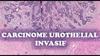 LE CARCINOME UROTHELIAL INVASIF SousTypes – PATHOLOGIE [upl. by Delcina]