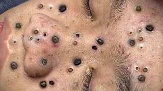 Big Cystic Acne Blackheads Extraction Blackheads amp Milia Whiteheads Removal Pimple Popping  1213 [upl. by Jobyna]