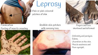 Leprosy signs and symptoms Treatment Hansens Disease [upl. by Dodd549]