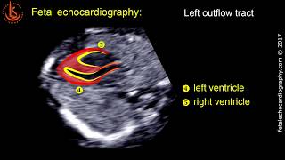 Fetal echocardiography at 1113 weeks Technique of Early Heart Scan [upl. by Yetak]