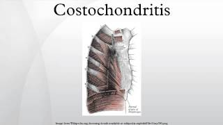 Costochondritis [upl. by Aldon809]