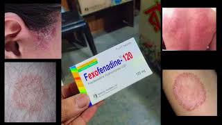 Allegra Tablet Fexofenadine 120 mg Use Dose Side Effects and Price in bengali [upl. by Yrellam]