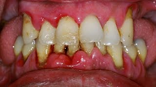 Gengivite e Periodontite  Gengiva Sangrando e Dentes Ficando Moles Tratamento [upl. by Hanauq344]