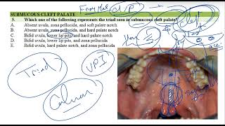 Submucous Cleft Palate [upl. by Mcwherter]