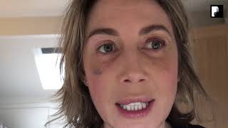 Blepharoplasty Video Diary  Day 10 After Surgery 8 of 15 [upl. by Ylas285]