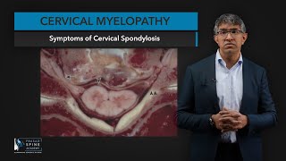 Cervical Myelopathy What You Need to Know [upl. by Anne-Marie510]