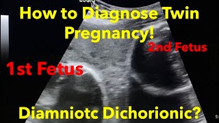 Twin Pregnancy  Diamniotic Dichorionic how to diagnose  easy steps [upl. by Oravla]