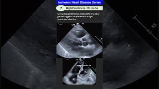 Ischemic Heart Disease 7 Right Ventricle MI [upl. by Amaryllis]