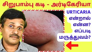 அர்டிகேரியா தோல் அழற்சி மருத்துவம்  urticaria hives skin allergy treatment [upl. by Lolande]