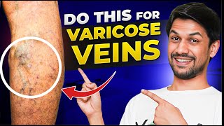 VARICOSE VEINS explained under 10 minutes  Saurabh Bothra Yoga [upl. by Asirac212]