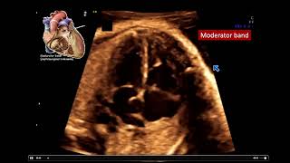 2022 Fetal Echocardiography Normal and Abnormal Hearts  A Video CME Teaching Activity [upl. by Uhthna472]