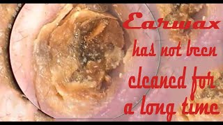 Hardless earwax Earwax has not been cleaned for a long time 2 [upl. by Javed]