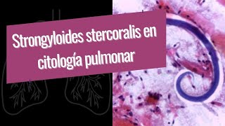 Strongyloides stercoralis en citología pulmonar [upl. by Nyrual]