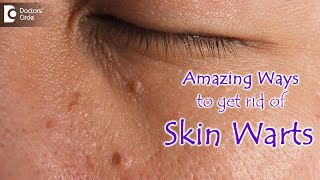 AMAZING WAYS TO GET RID OF SKIN WARTS  Skin Wart Removal Tips  DrNischal K  Doctors Circle [upl. by Eisset64]