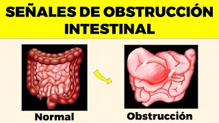 OBSTRUCCIÓN INTESTINAL Señales de Alerta Que Nunca Debes Ignorar [upl. by Evangelia]