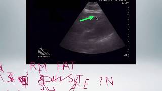 Cardiac Effusions and Tamponade ultrasoundecho [upl. by Bentley203]