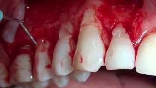 Root coverage with Alloderm  Recobrimento Radicular com Alloderm [upl. by Hedve]