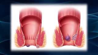 Hurting From Hemorrhoids [upl. by Inaleon]