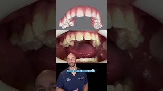 Can Invisalign Fix My Bite and Straighten My Teeth 2023 [upl. by Zachary115]