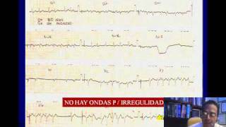 ELECTROCARDIOGRAFIA CURSO TALLER PARTE 3 TAQUIARRITMIAS 1wmv [upl. by Asiil]