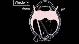 Vitreous 3 Vitrectomy Surgery [upl. by Munmro]