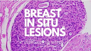 Breast In Situ Lesions Kurt’s Notes pathagonia [upl. by Werda]