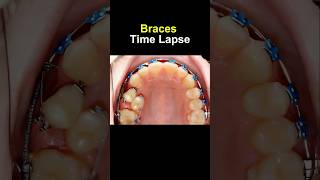 Braces time lapse Before and after transform braces orthodontist bracesoff dentist [upl. by Aciria]