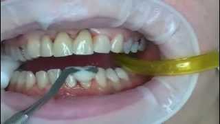 What are dental veneers [upl. by Aicined499]