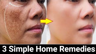 Remove Face Pigmentation Naturally [upl. by Ariaec]