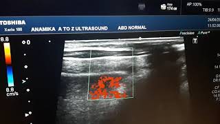 Disseminated cysticercosis in muscle ultrasound [upl. by Haduj122]