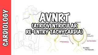 AVRNT atrioventricular reentry tachycardia  causes pathophysiology treatment [upl. by Acirretahs598]