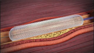 What is a Coronary Angioplasty [upl. by Eimak]