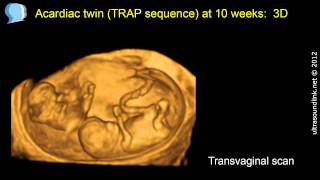 Acardiac twin TRAP sequence at 10 weeks [upl. by Hizar]