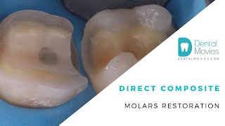 Direct composite molars restoration [upl. by Wincer]