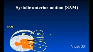 SAM  Systolic Anterior Motion in Feline Cardiomyopathy [upl. by Hofstetter]