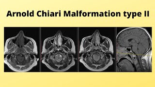 Arnold chiari malformation TYPE II [upl. by Marisa439]