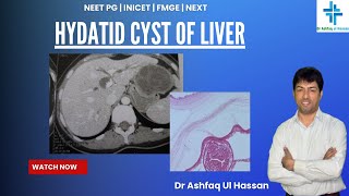 Hydatid Cyst of Liver  An important Question asked in FMGE 2024  Expected in NEET PG [upl. by Ocsisnarf]