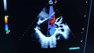 Primary pulmonary hypertension [upl. by Tolliver354]